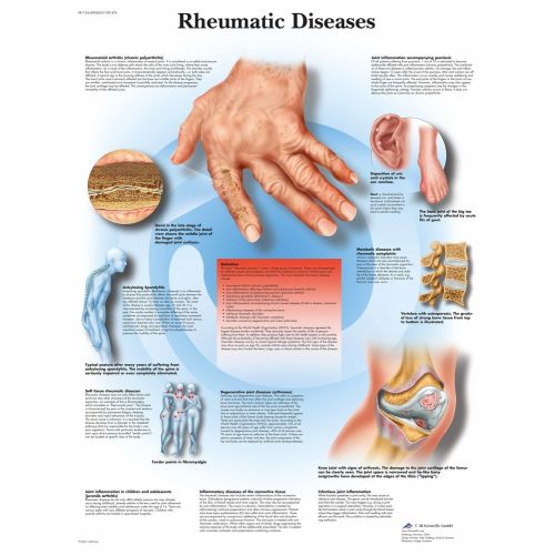 Rheumatic Diseases Poster The Rheumatic Diseases Poster features a detailed overview of various rheumatic diseases, their